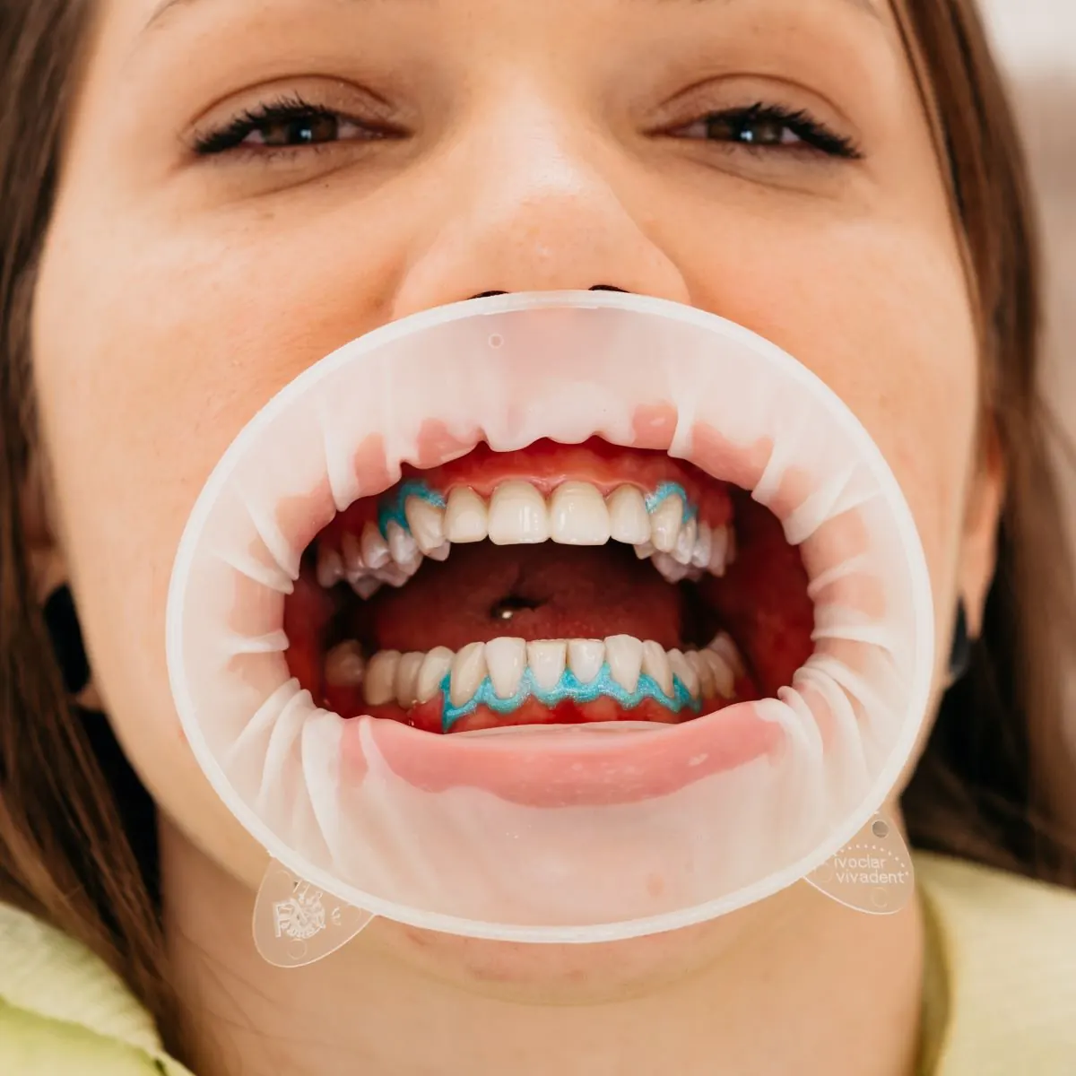 Galerija osmijeha – rezultati estetske stomatologije Dental Centar Apex