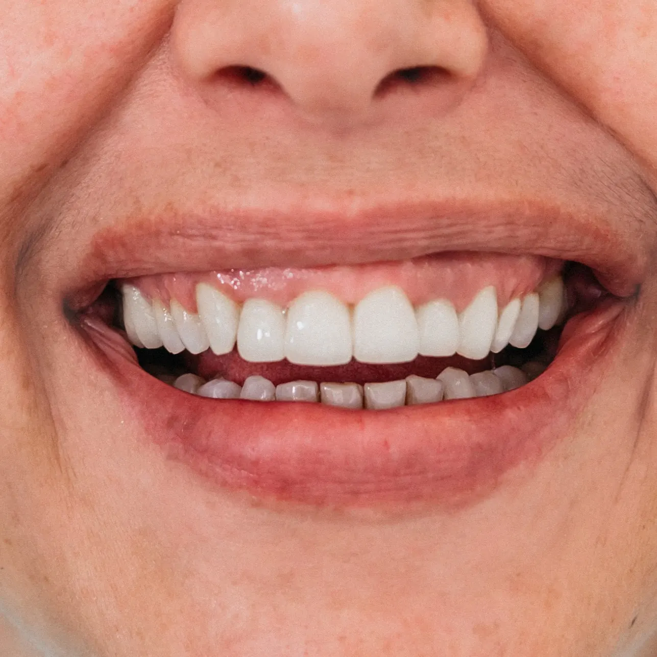 Galerija osmijeha – rezultati estetske stomatologije Dental Centar Apex