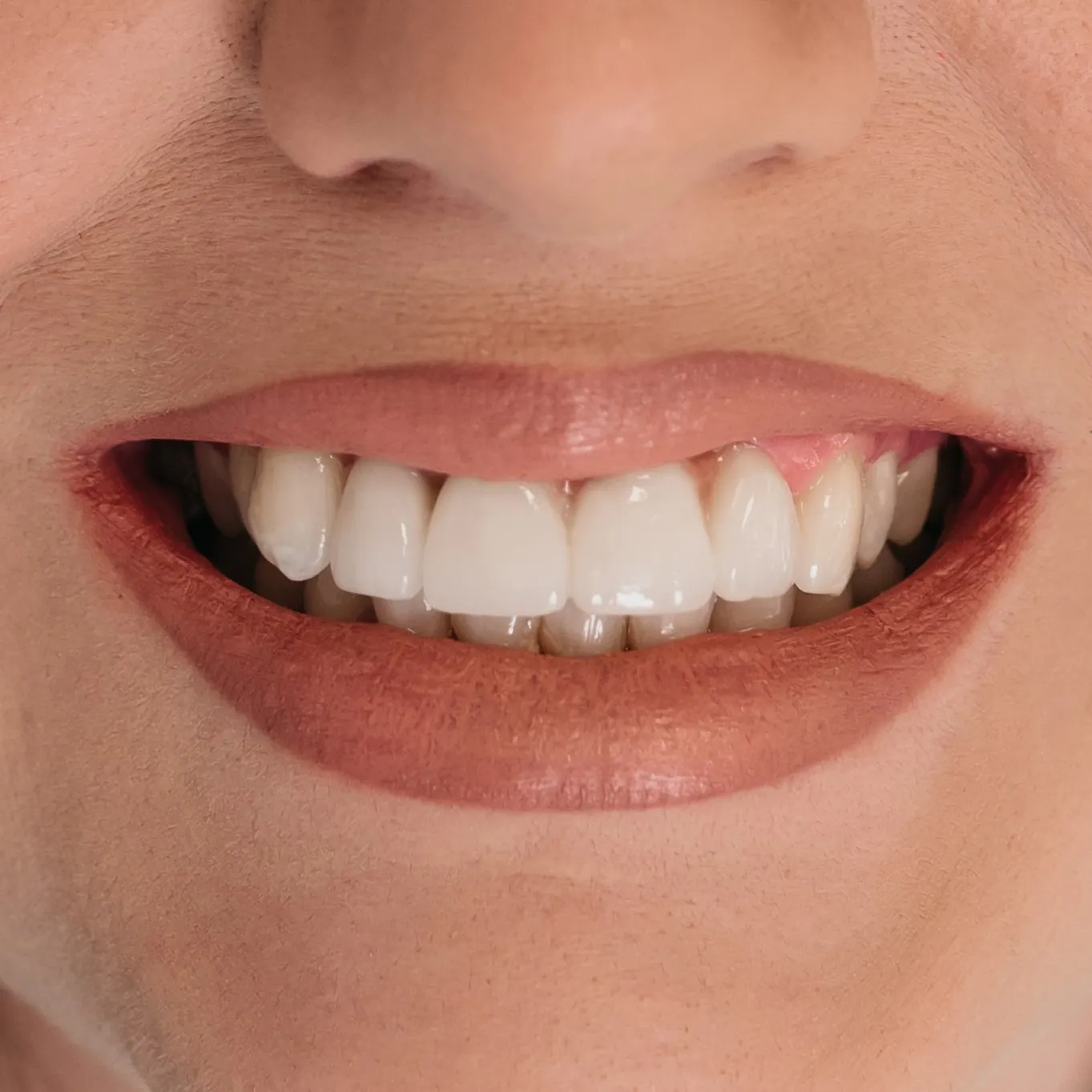 Galerija osmijeha – rezultati estetske stomatologije Dental Centar Apex